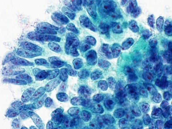 細胞診断（細胞診の画像2