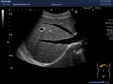 腹部超音波検査の画像2