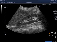 腹部超音波検査の画像1
