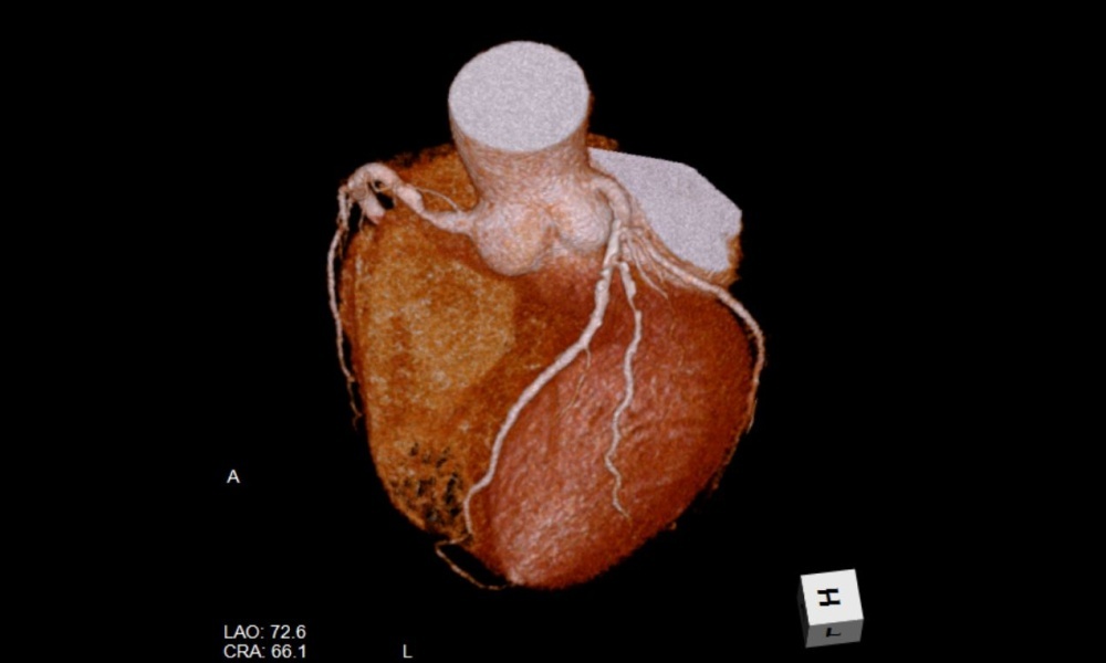 心臓造影CT（3D VR画像）