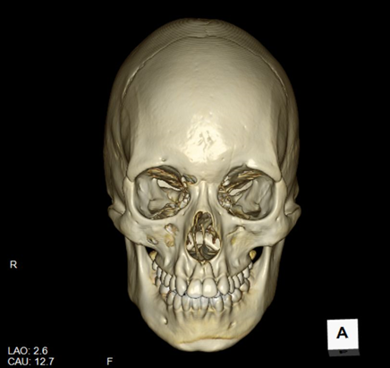 頭部単純CT（3D VR画像）