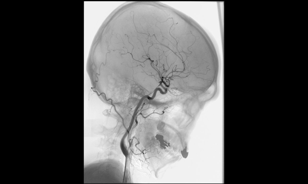 頭部 総頸動脈造影の画像1