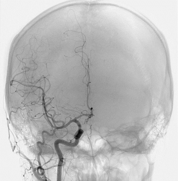 頭部 総頸動脈造影の画像2