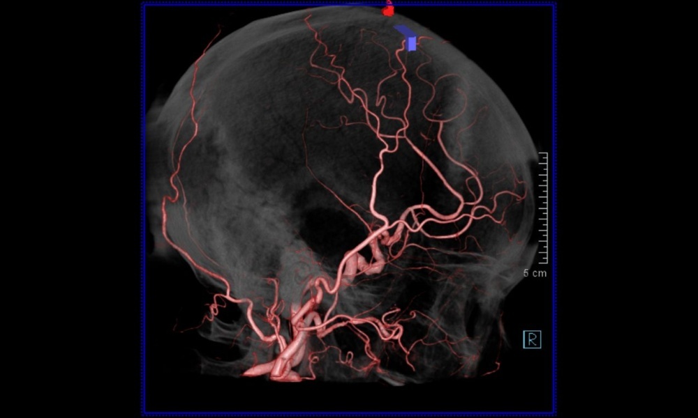 頭部 総頸動脈造影　Dyna CTの画像1