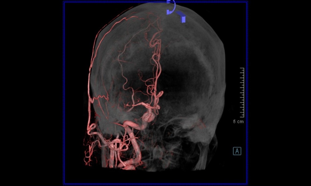 頭部 総頸動脈造影　Dyna CTの画像2