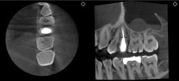 歯のレントゲン写真2