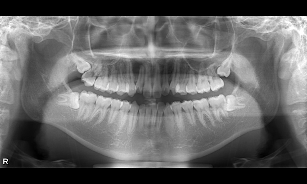 歯のレントゲン写真3