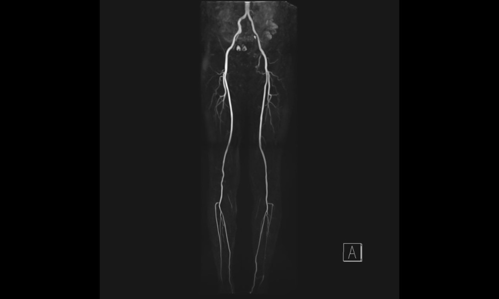 下肢造影MRI（MRA画像）