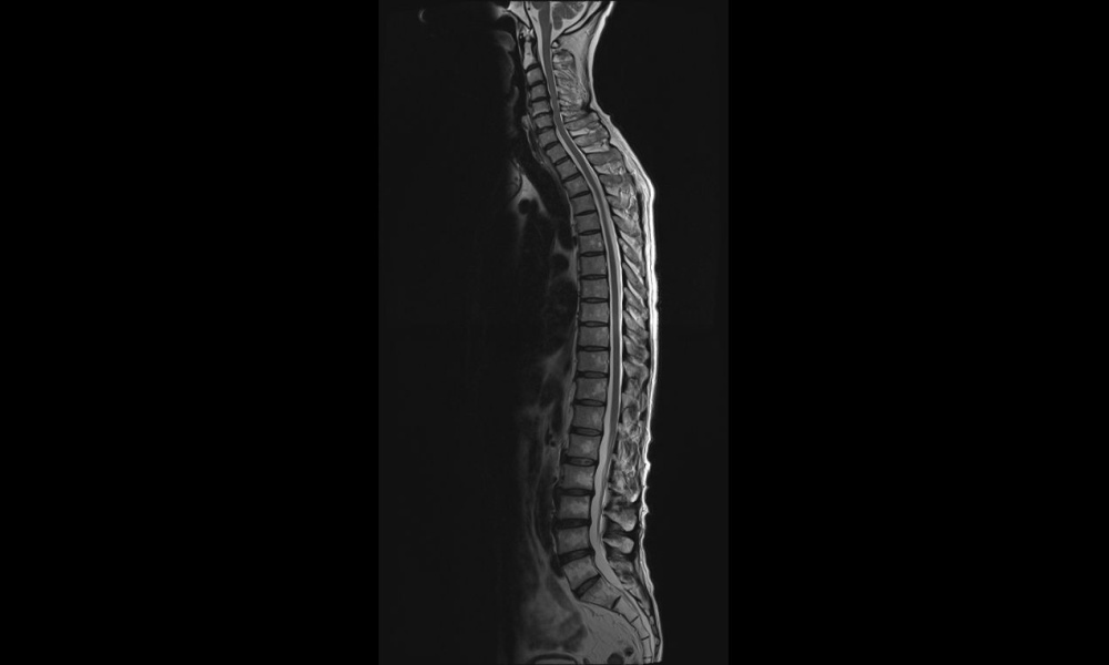 全脊柱　単純MRIの画像