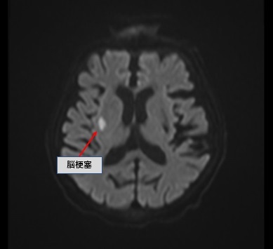 頭部単純MRI（DW画像）